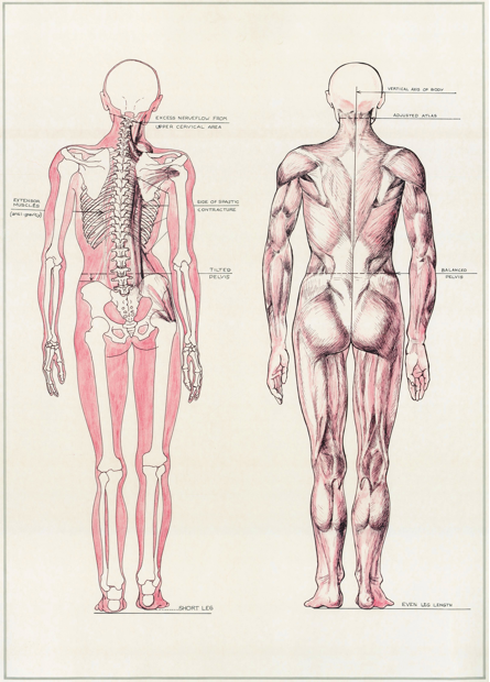 The Misaligned Spine & The Normal Spine 